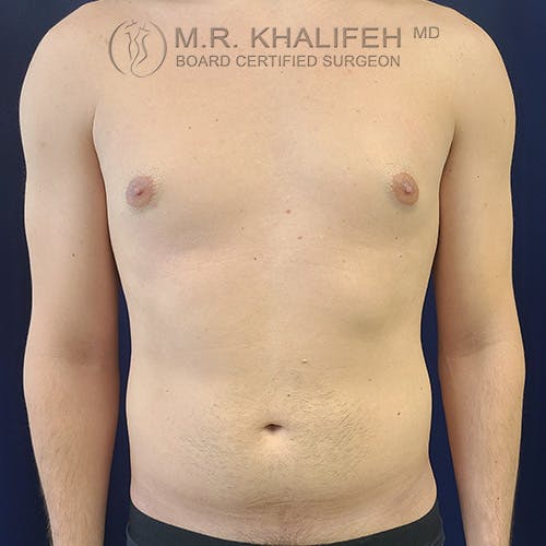Abdominal Liposuction Gallery - Patient 39769308 - Image 1