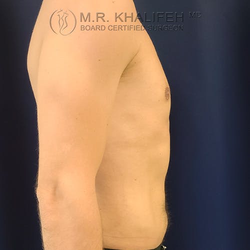 Abdominal Liposuction Gallery - Patient 39769308 - Image 6