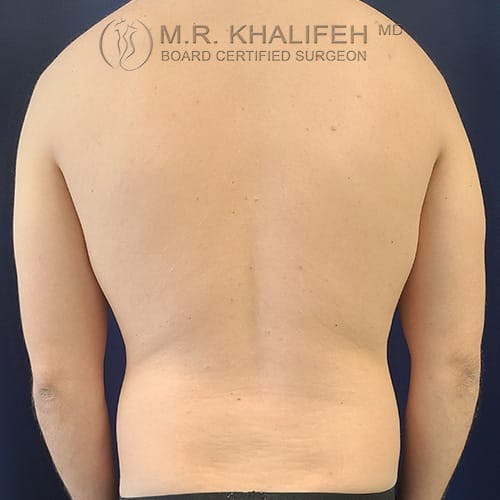Male Liposuction Gallery - Patient 39769363 - Image 11