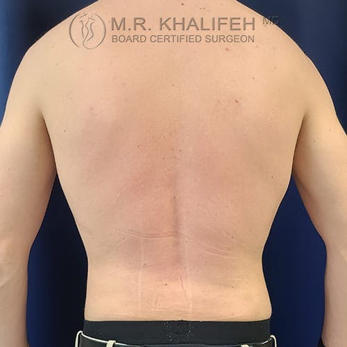 Flank-Lower Back Liposuction Gallery - Patient 39769386 - Image 2