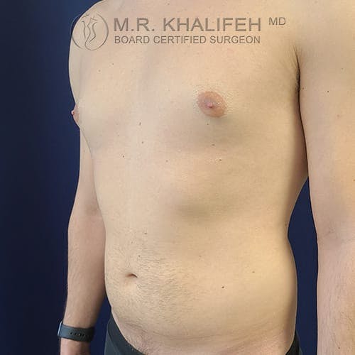 Flank-Lower Back Liposuction Gallery - Patient 39769386 - Image 9