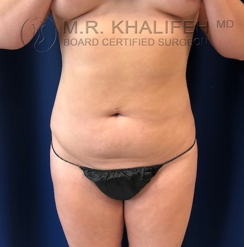 Abdominal Liposuction Gallery - Patient 40623066 - Image 1