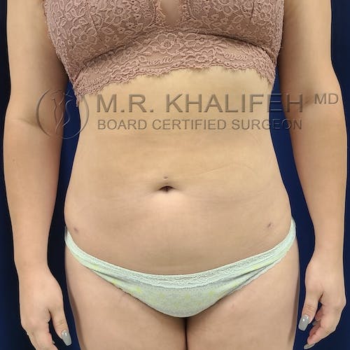 Abdominal Liposuction Gallery - Patient 40623066 - Image 2
