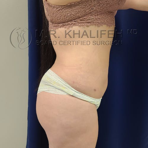 Abdominal Liposuction Gallery - Patient 40623066 - Image 4