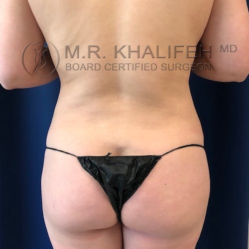 Abdominal Liposuction Gallery - Patient 40623066 - Image 7
