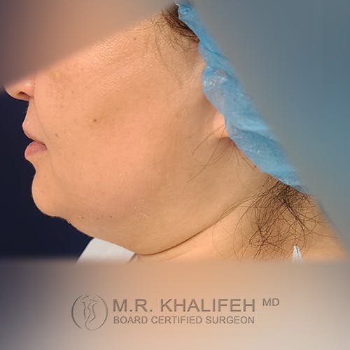 Chin & Neck Liposuction Gallery - Patient 41507668 - Image 1