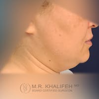 Buccal Fat Pad Excision Gallery - Patient 41507731 - Image 1