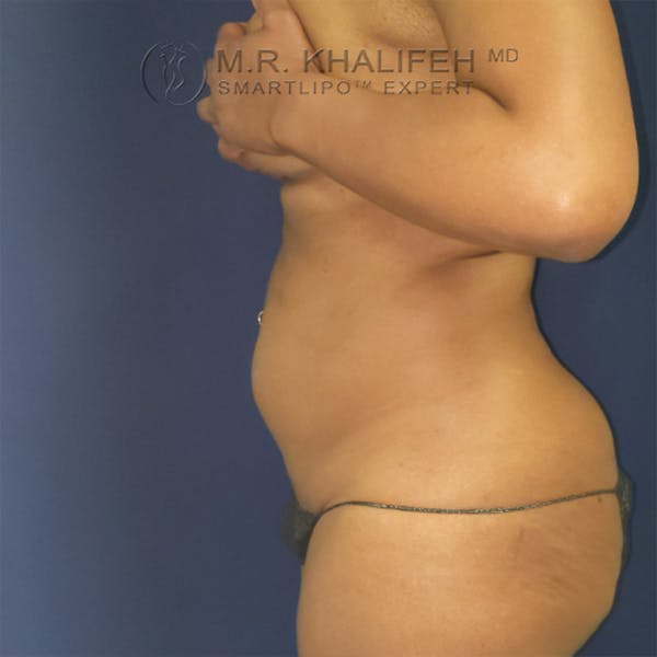 Abdominal Liposuction Gallery - Patient 44540436 - Image 5