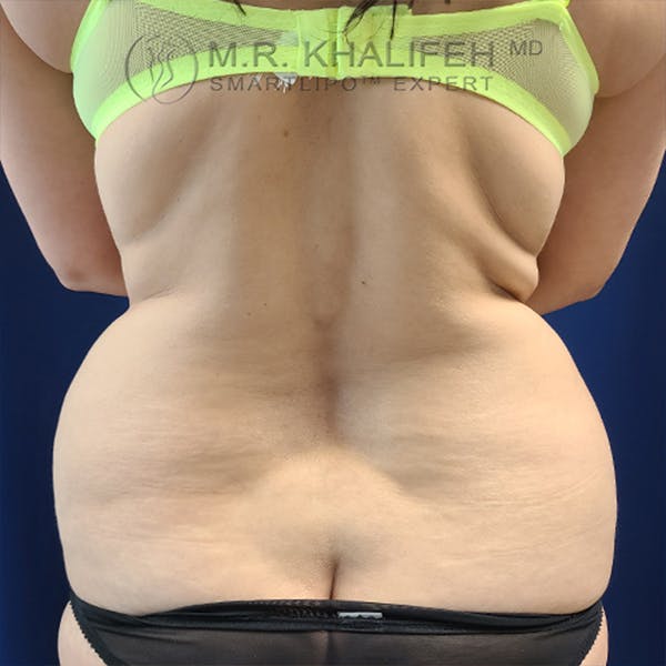 Flank-Lower Back Liposuction Gallery - Patient 44541870 - Image 1