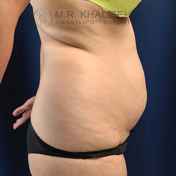 Flank-Lower Back Liposuction Gallery - Patient 44541870 - Image 3