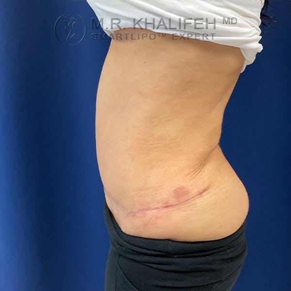 Flank-Lower Back Liposuction Gallery - Patient 44541870 - Image 6