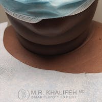 Chin and Neck Liposuction Gallery - Patient 44543010 - Image 1