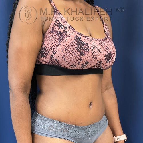 Tummy Tuck Gallery - Patient 56377241 - Image 4