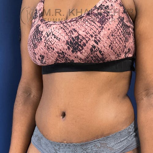 Tummy Tuck Gallery - Patient 56377241 - Image 8