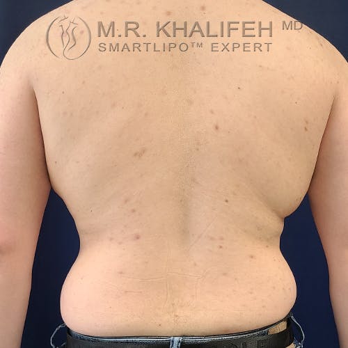 Male Liposuction Gallery - Patient 61120579 - Image 1
