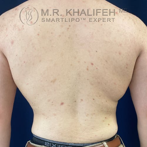 Flank-Lower Back Liposuction Gallery - Patient 61120582 - Image 2