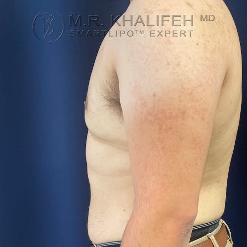 Male Liposuction Gallery - Patient 61120579 - Image 12
