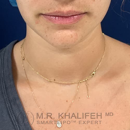 Chin and Neck Liposuction Gallery - Patient 99660579 - Image 5