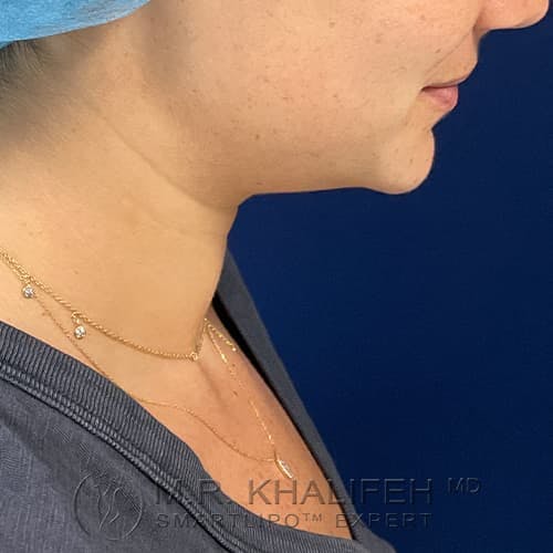 Chin & Neck Liposuction Gallery - Patient 74784566 - Image 3