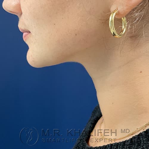 Chin and Neck Liposuction Gallery - Patient 99660579 - Image 2