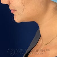 Chin and Neck Liposuction Gallery - Patient 99660579 - Image 1
