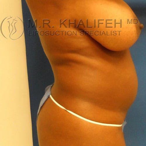 Flank-Lower Back Liposuction Gallery - Patient 84256661 - Image 5