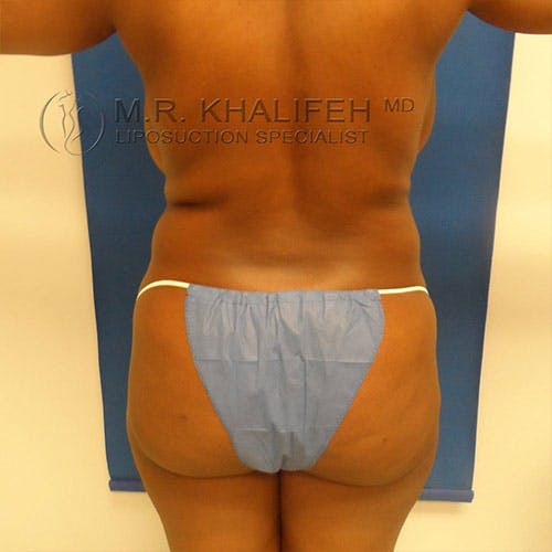 Flank-Lower Back Liposuction Gallery - Patient 84256661 - Image 1