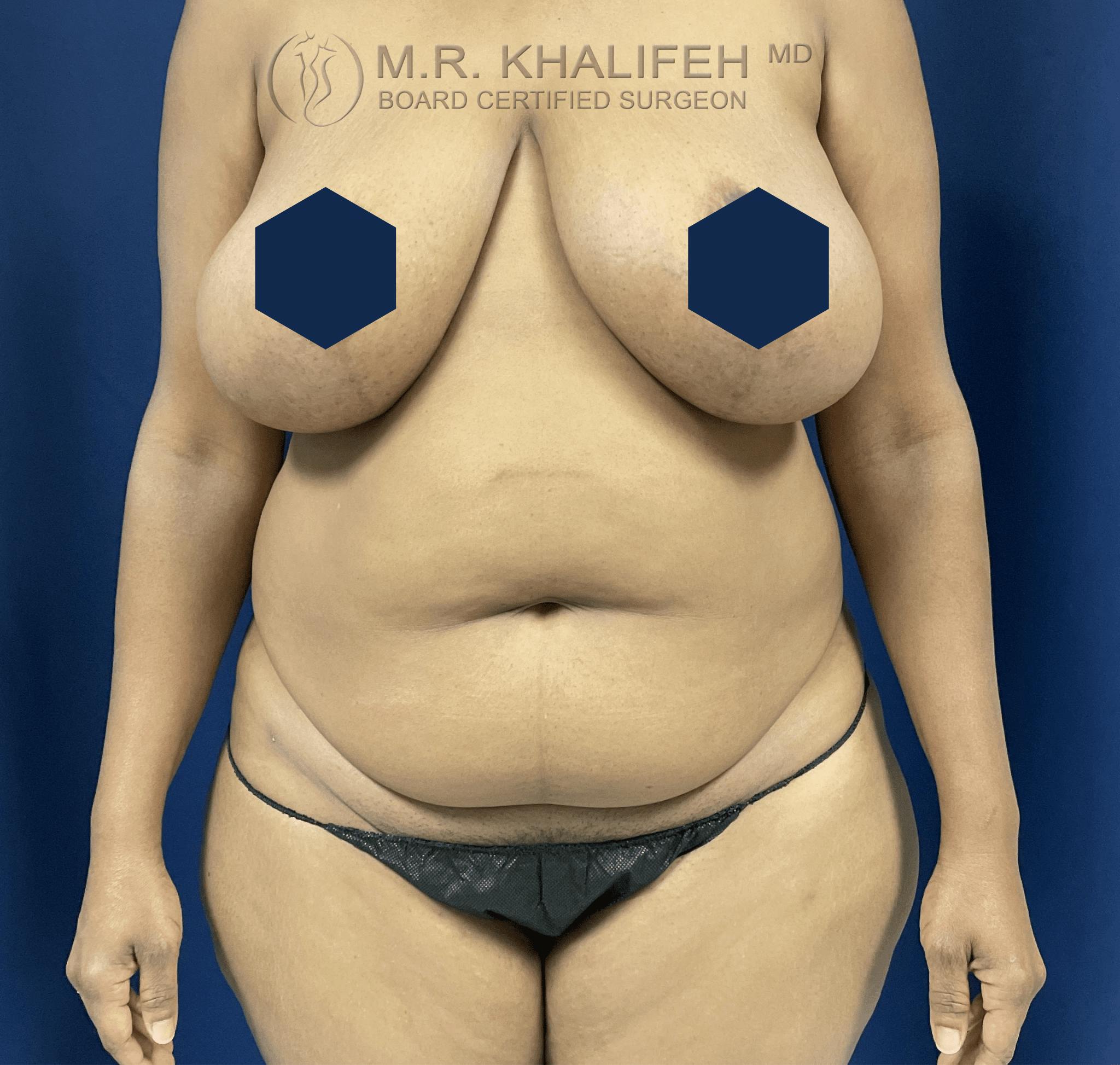 Mini Tummy Tuck Gallery - Patient 100387720 - Image 1