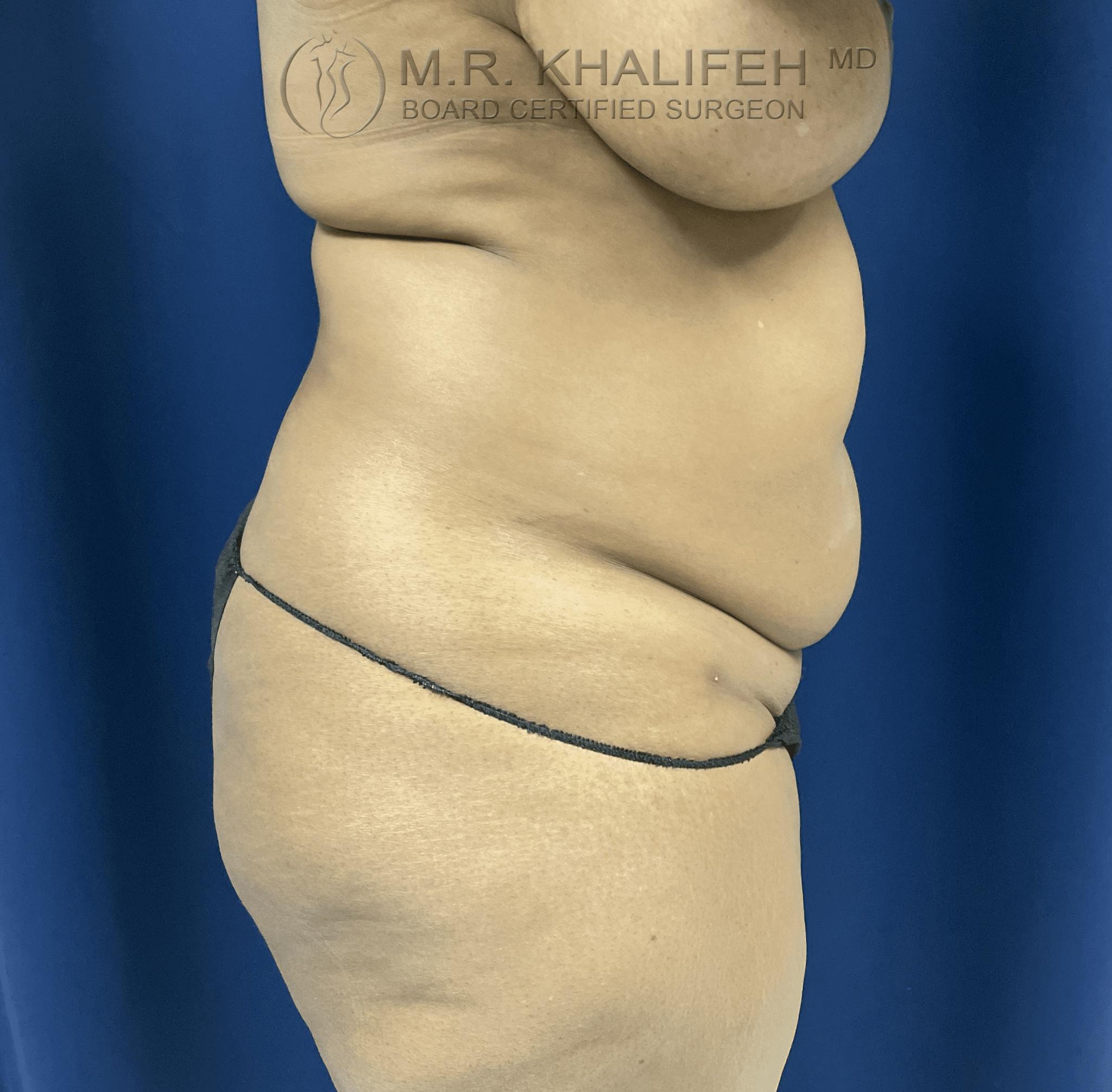 Mini Tummy Tuck Gallery - Patient 100387720 - Image 3