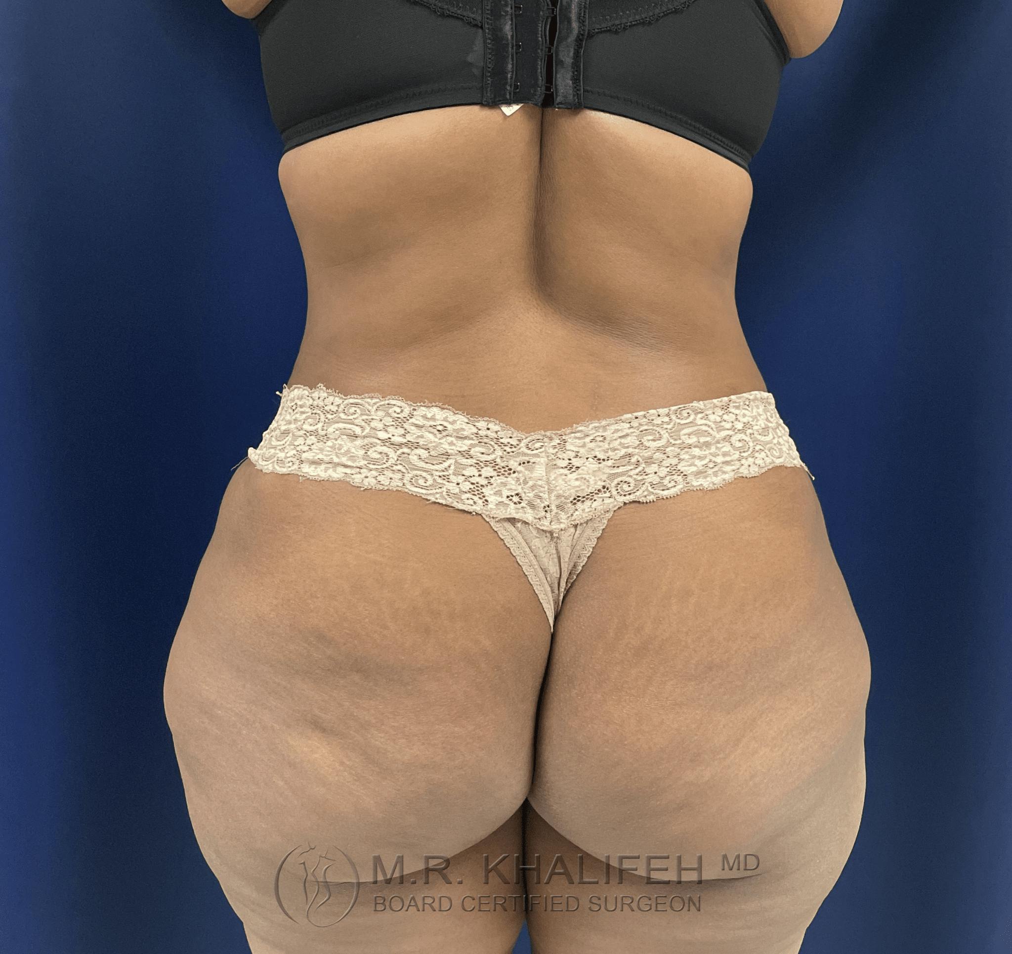 Mini Tummy Tuck Gallery - Patient 100387720 - Image 6