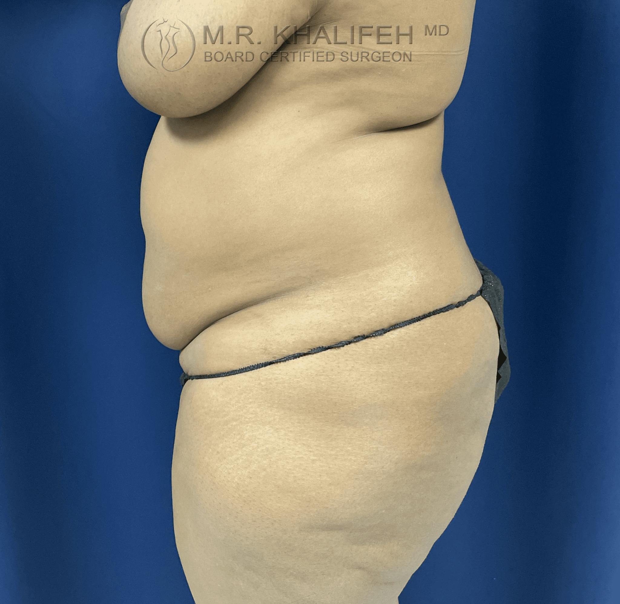 Mini Tummy Tuck Gallery - Patient 100387720 - Image 7