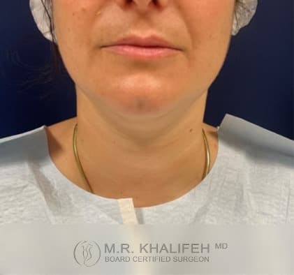 Chin and Neck Liposuction Gallery - Patient 101059800 - Image 1