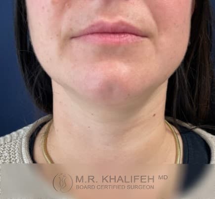 Chin and Neck Liposuction Gallery - Patient 101059800 - Image 2