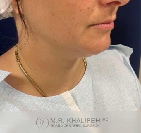 Chin and Neck Liposuction Gallery - Patient 101059800 - Image 3