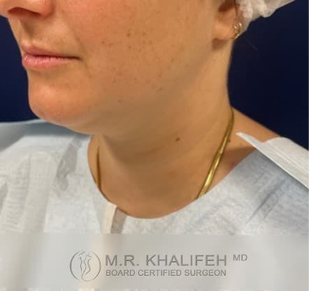 Chin and Neck Liposuction Gallery - Patient 101059800 - Image 7