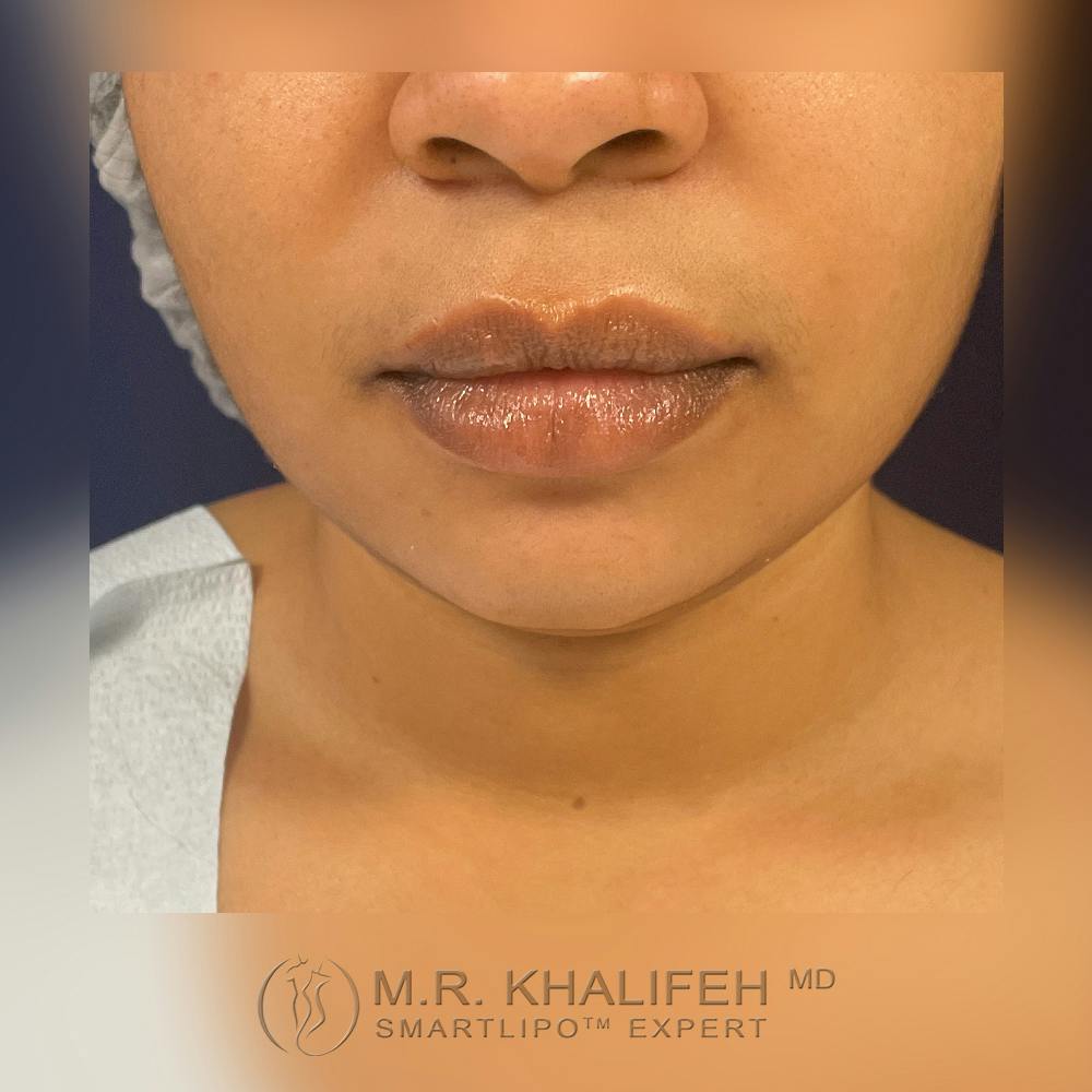 Buccal Fat Pad Excision Gallery - Patient 120416612 - Image 1