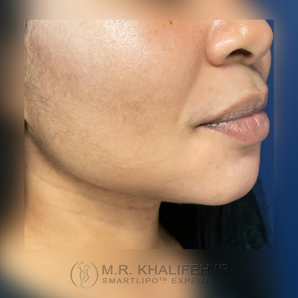 Chin and Neck Liposuction Gallery - Patient 120416603 - Image 4