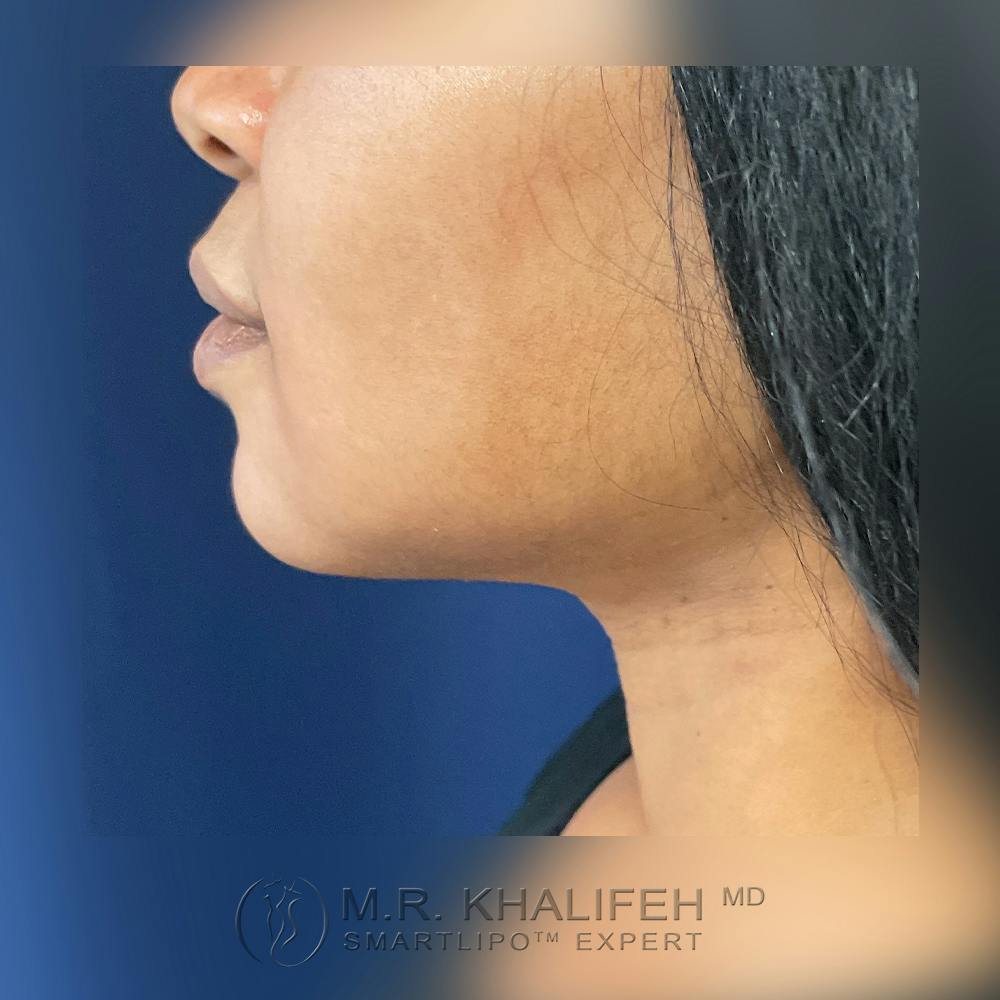 Chin and Neck Liposuction Gallery - Patient 120416603 - Image 10