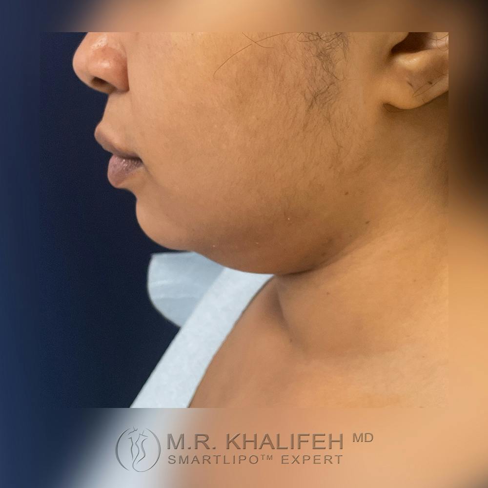 Chin and Neck Liposuction Gallery - Patient 120416603 - Image 9