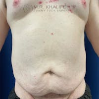 Male Tummy Tuck Gallery - Patient 120723296 - Image 1