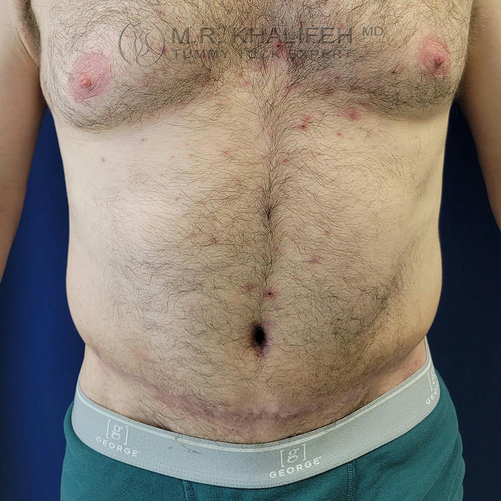 Male Tummy Tuck Gallery - Patient 120723296 - Image 2
