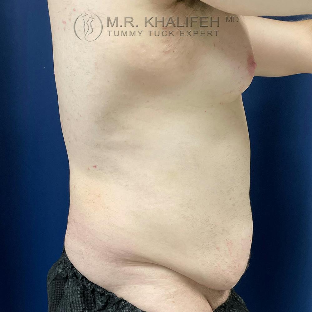 Male Tummy Tuck Gallery - Patient 120723296 - Image 3