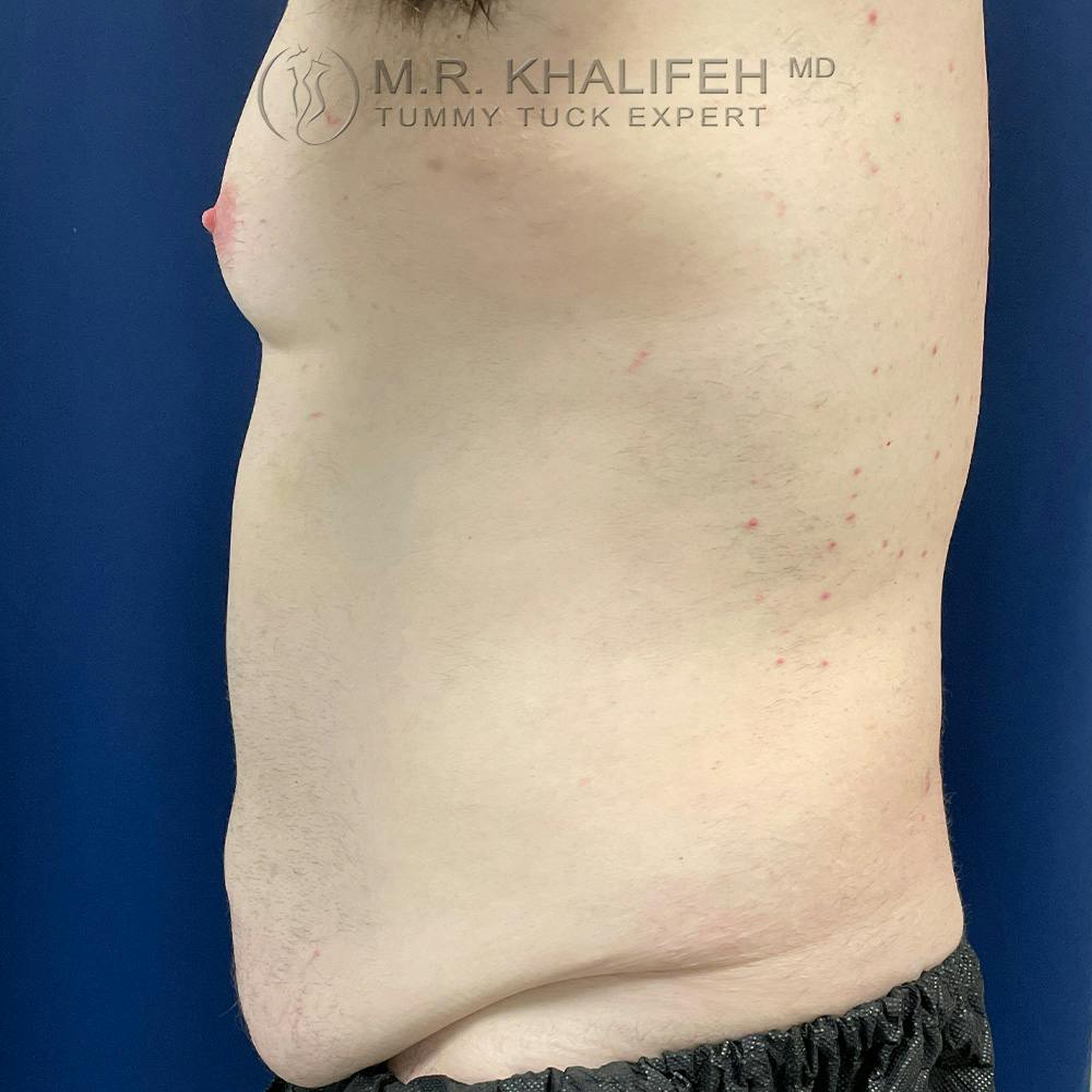 Male Tummy Tuck Gallery - Patient 120723296 - Image 5