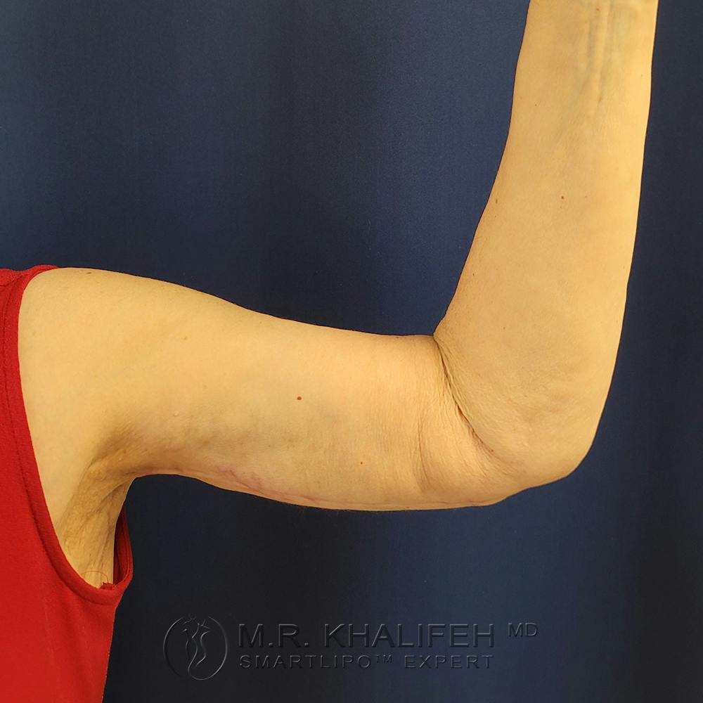Arm Lift Gallery - Patient 94080910 - Image 4