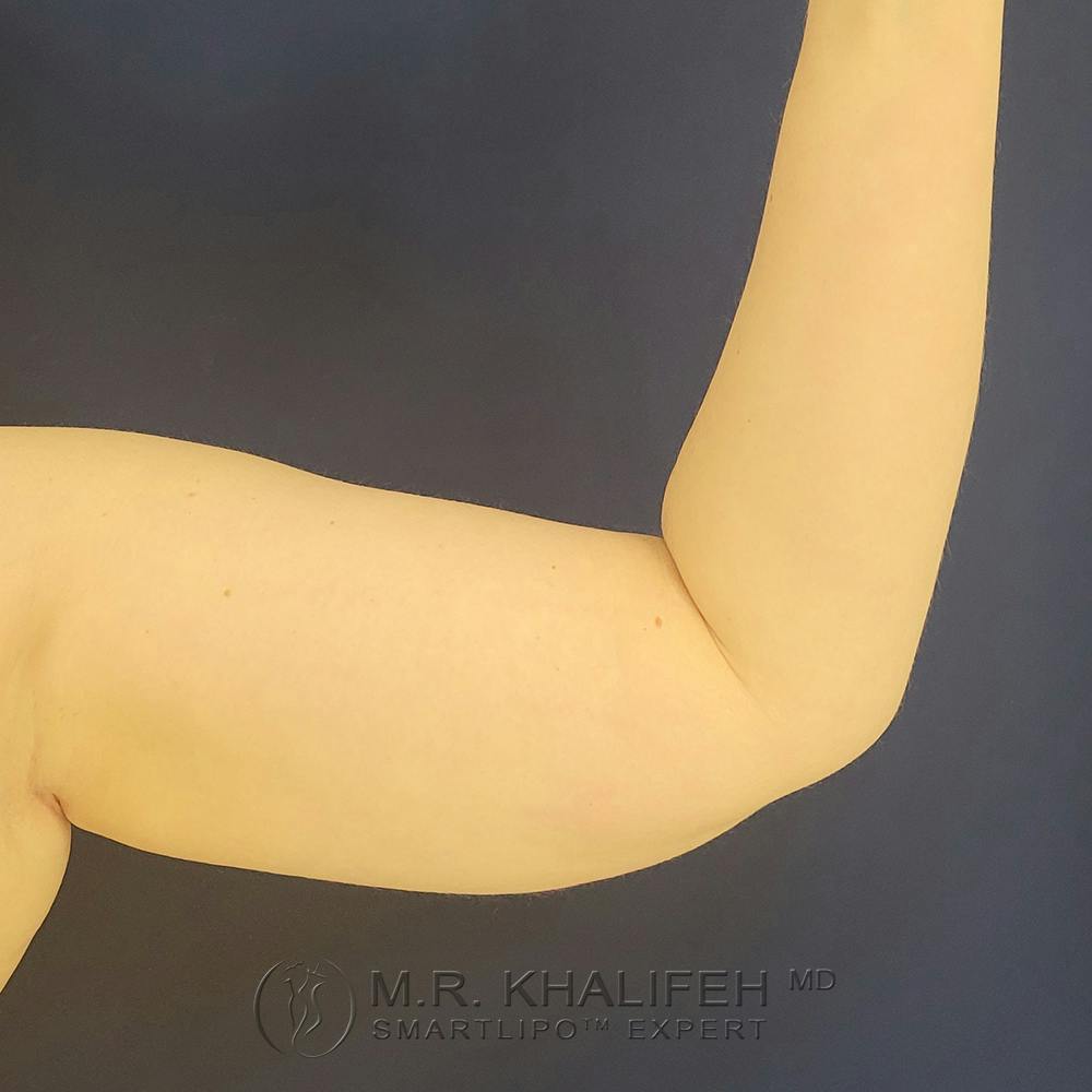 Arm Liposuction Gallery - Patient 121765621 - Image 3