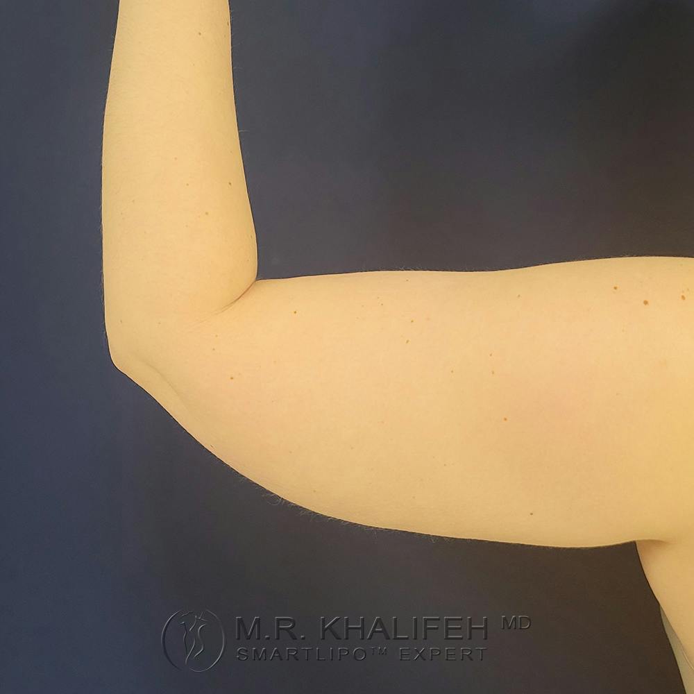 Arm Liposuction Gallery - Patient 121765621 - Image 5