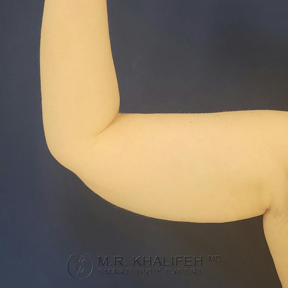 Arm Liposuction Gallery - Patient 121765621 - Image 7