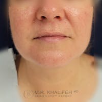 Chin and Neck Liposuction Gallery - Patient 121765630 - Image 1