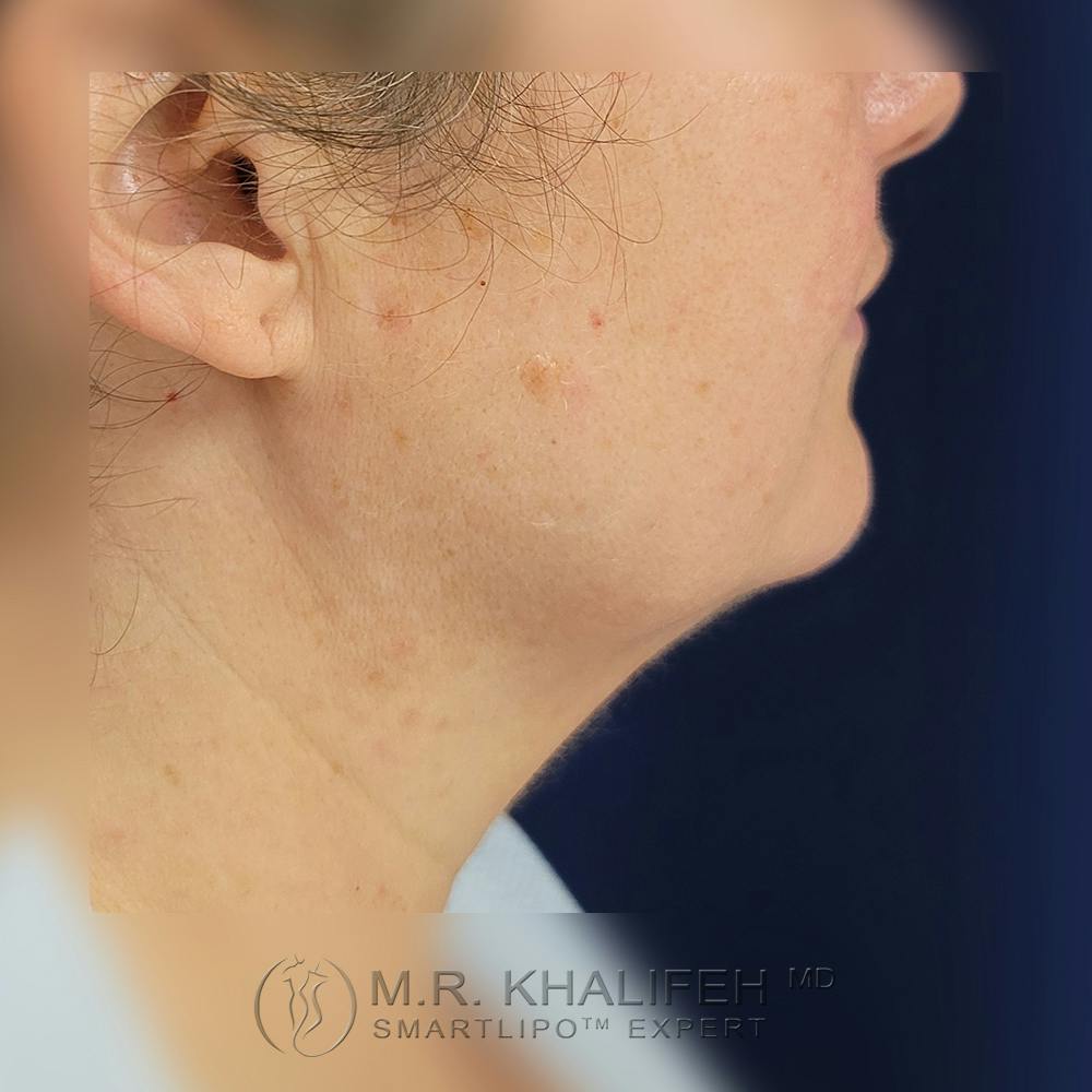 Chin and Neck Liposuction Gallery - Patient 121765630 - Image 3