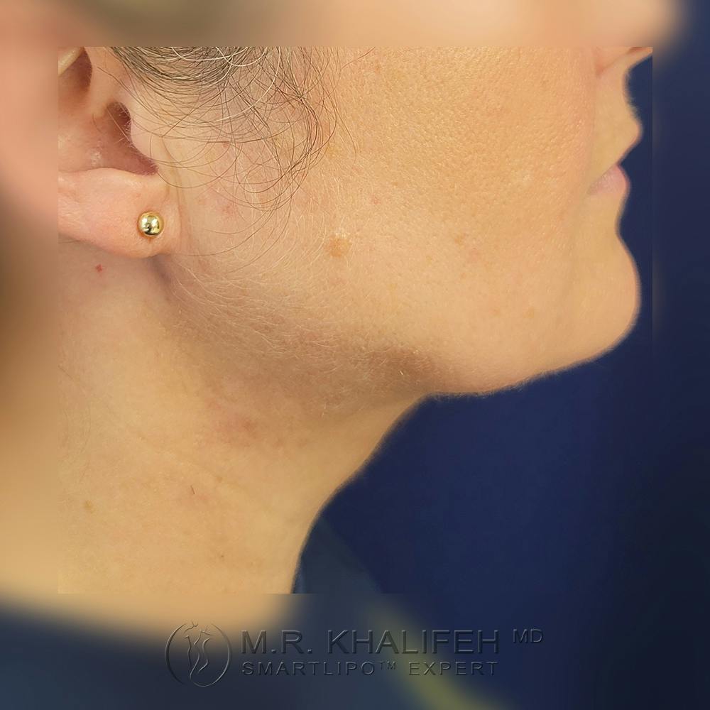 Chin and Neck Liposuction Gallery - Patient 121765630 - Image 4